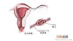 宫外孕手术治疗