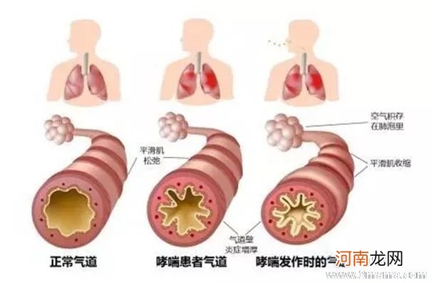 小儿哮喘常见症状是哪些