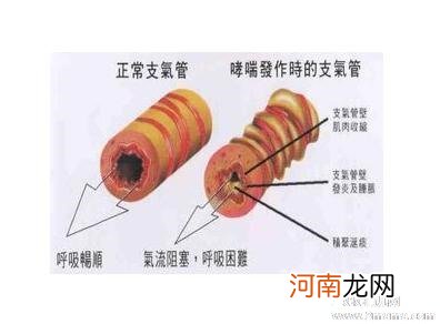 儿童哮喘的主要症状是什么