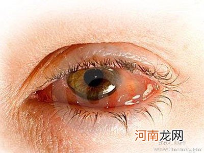怎么预防眼睛出现红血丝
