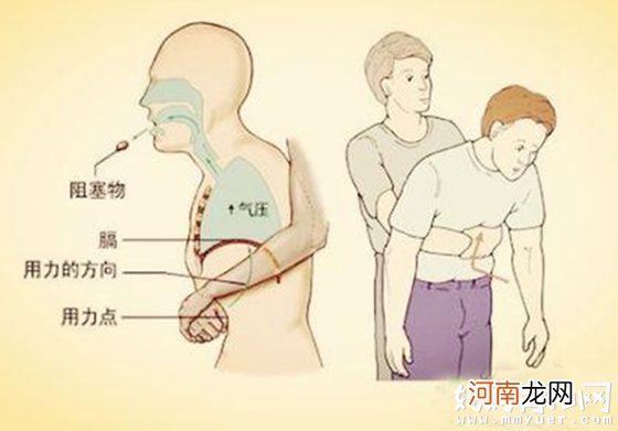 图解 海姆立克急救法的标准动作 拯救了百万人的方法