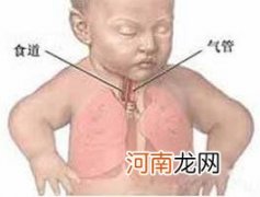 小儿喘息性支气管炎有什么特点？