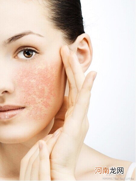 皮肤过敏患者日常如何护理