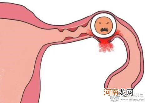 孕前认识宫外孕是什么 详讲造成宫外孕的三种原因