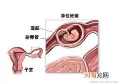 宫外孕的确诊方法