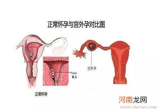 宫外孕的症状