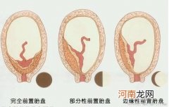 二胎胎盘后壁危险性