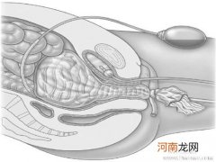 产后出血五个保守治疗法