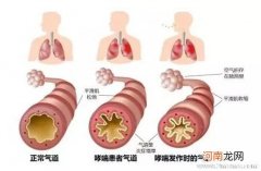 小儿哮喘的症状都有哪些呢？