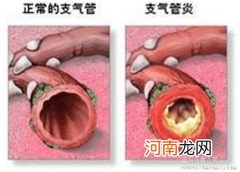 支气管炎的主要病因