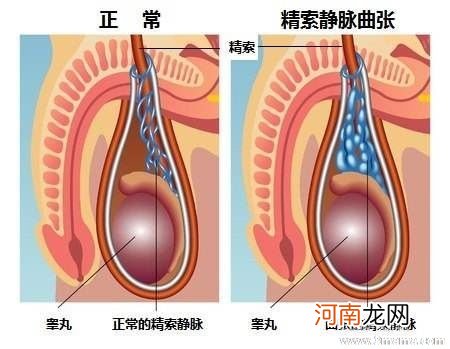 男性不育跟精索静脉曲张是否有关？精索静脉曲张检查项目分享 ...