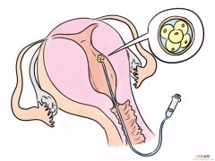 试管婴儿移植后感觉？关于试管用药方面的相关问题