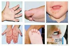 手足口病疾病的症状是什么呢