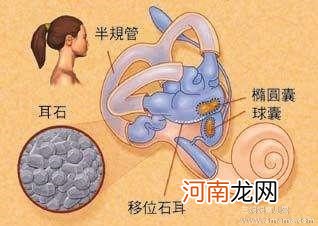 图 无端头晕原是耳石移位