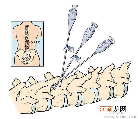 剖二胎都会抗麻药吗