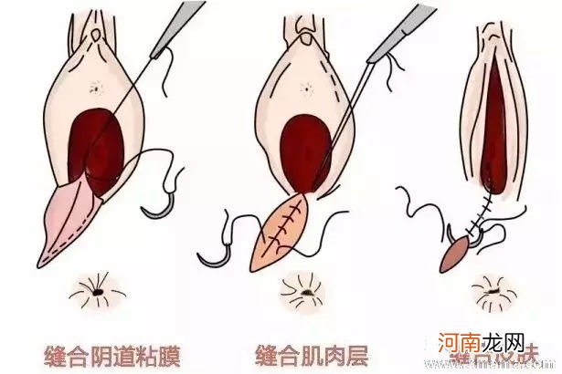 顺产缝合线多久吸收完