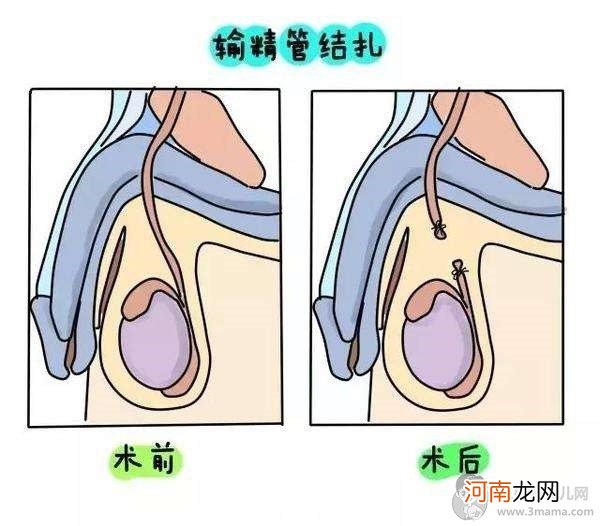 中国女人结扎的真相，看完你还敢结扎吗？