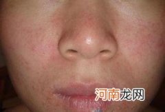 治疗脸部皮肤过敏的3种方法