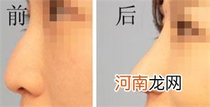 X型腿矫正带有用吗