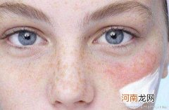 脸部皮肤过敏原因有哪些?