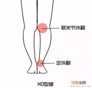 O型腿矫正方法