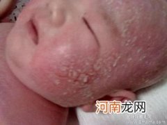 婴儿湿疹有什么症状？