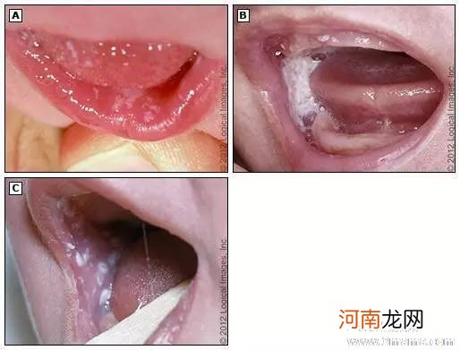 婴幼儿“鹅口疮”