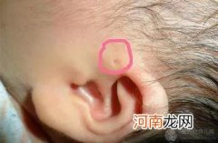 耳前瘘管不能乱挤：为什么宝宝耳朵旁边有个小洞？
