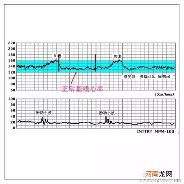 胎心监护的评分标准