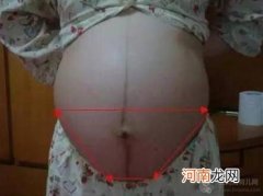 妊娠线看男女准吗