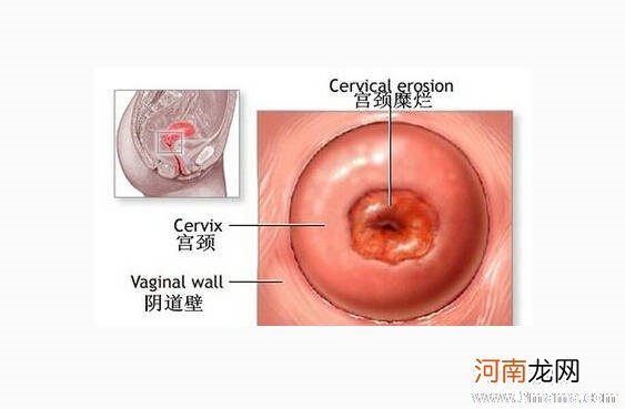 宫颈糜烂的原因