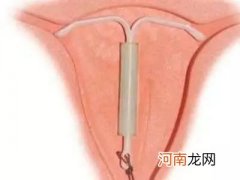 什么是女性结扎手术