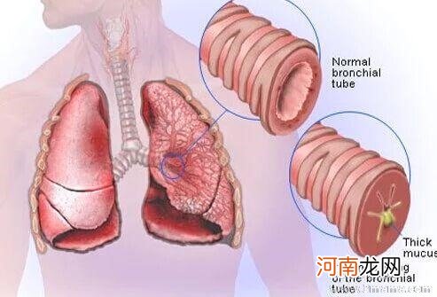 慢性支气管炎混淆的疾病