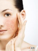 过敏肌肤冬季皮肤特点有哪些？