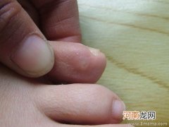 脚上长鸡眼怎么治