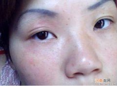 脸部皮肤过敏是什么引起的