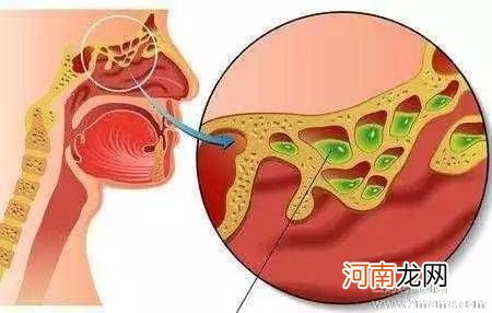 室内外温差太大易诱发哮喘