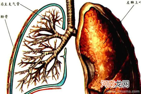 气管炎的五大多发并发症