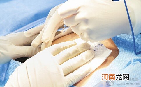 头胎剖腹产 二胎剖腹产刀口怎么开