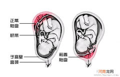 前置胎盘原因