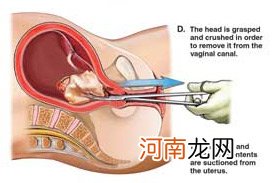 人流给女人带来多大灾难