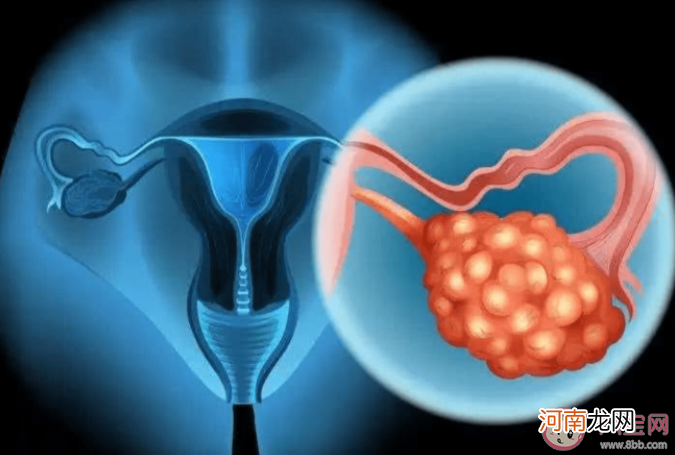 卵巢癌|约70%卵巢癌患者确诊已是晚期 为什么卵巢癌难以发现