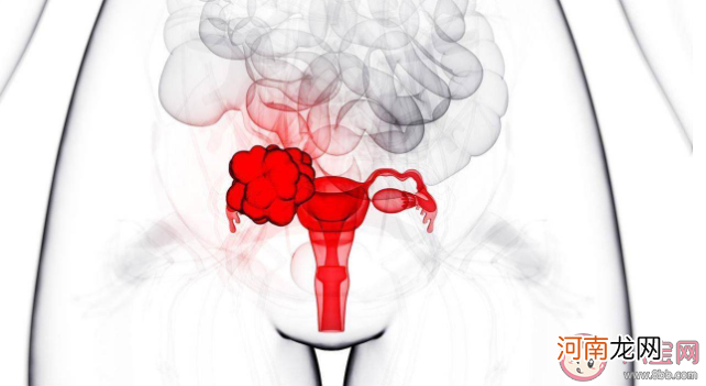 卵巢癌|卵巢癌容易复发吗 哪些女性是卵巢癌高危人群