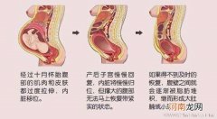 刨腹产坐月子注意事项