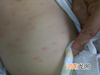 皮肤过敏会出现什么症状呢?