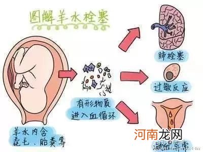 羊水栓塞的预防措施