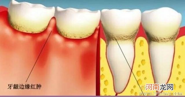 如何预防牙龈出血