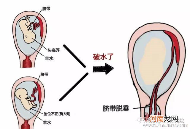 什么是破水