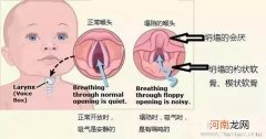 新生儿呼噜是喉软骨软化吗