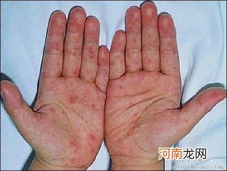 手足口病有哪些明显的症状特征呢
